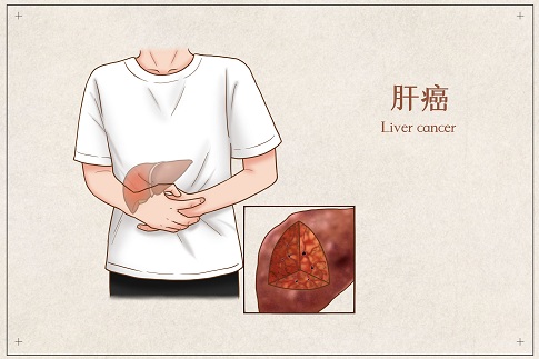 1653236443277979.jpg 攝圖網_401794893_banner_肝癌醫療插畫(企業商用).jpg