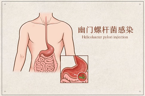 1656435302709896.jpg 攝圖網_401789751_banner_幽門螺桿菌感染醫療插畫(企業商用).jpg