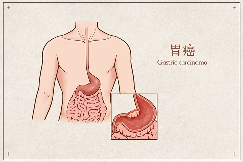 1657043293833817.jpg 攝圖網(wǎng)_401789678_胃癌醫(yī)療插畫(企業(yè)商用).jpg