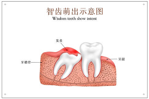 1659282417578019.jpg 攝圖網_401803631_智齒萌出示意圖(企業商用).jpg