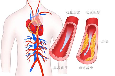 1664381360428575.jpg 攝圖網_401802186_banner_高血壓血管病變醫療插畫(非企業商用).jpg