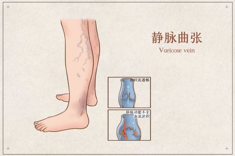 1689129778995583.jpg 攝圖網_401799108_banner_靜脈曲張醫療插畫(企業商用).jpg
