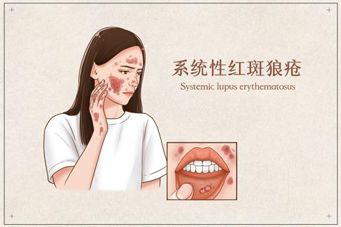 1701735967437085.jpg 攝圖網(wǎng)_401794490_系統(tǒng)性紅斑狼瘡醫(yī)療插畫(企業(yè)商用).jpg