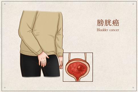 1706837148502931.jpg 攝圖網_401802457_膀胱癌醫療插畫(企業商用).jpg