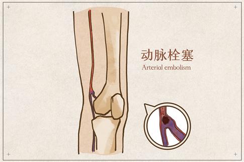 1708917056371122.jpg 攝圖網(wǎng)_401790480_動(dòng)脈栓塞醫(yī)療插畫(企業(yè)商用).jpg