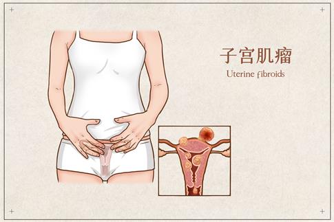 1709511232282588.jpg 攝圖網_401800161_子宮肌瘤醫療插畫(企業商用).jpg