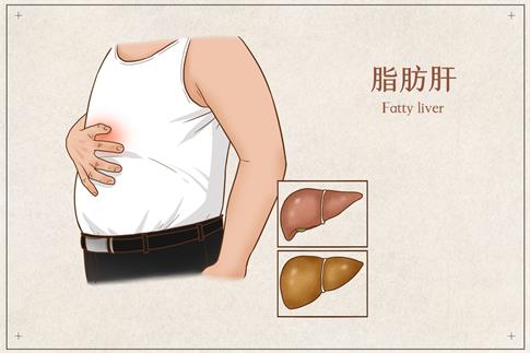 1718927263159194.jpg 攝圖網_401804062_脂肪肝醫療插畫(企業商用).jpg