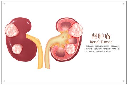 1751513635268596.jpg 攝圖網(wǎng)_402717159_banner_器官腎腫瘤解剖圖醫(yī)學(xué)分析插畫(企業(yè)商用).jpg